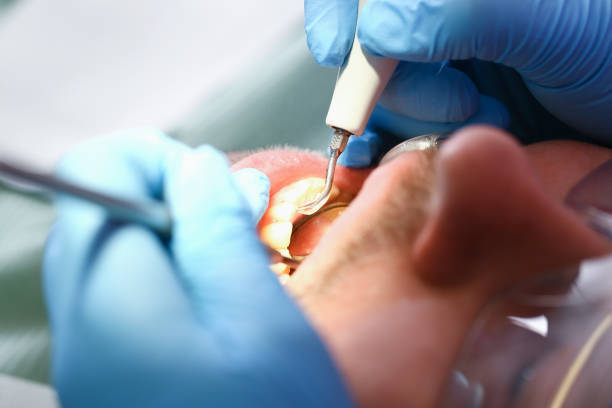 Best Knocked-Out Tooth (Avulsed Tooth) Treatment in Bourbon, IN